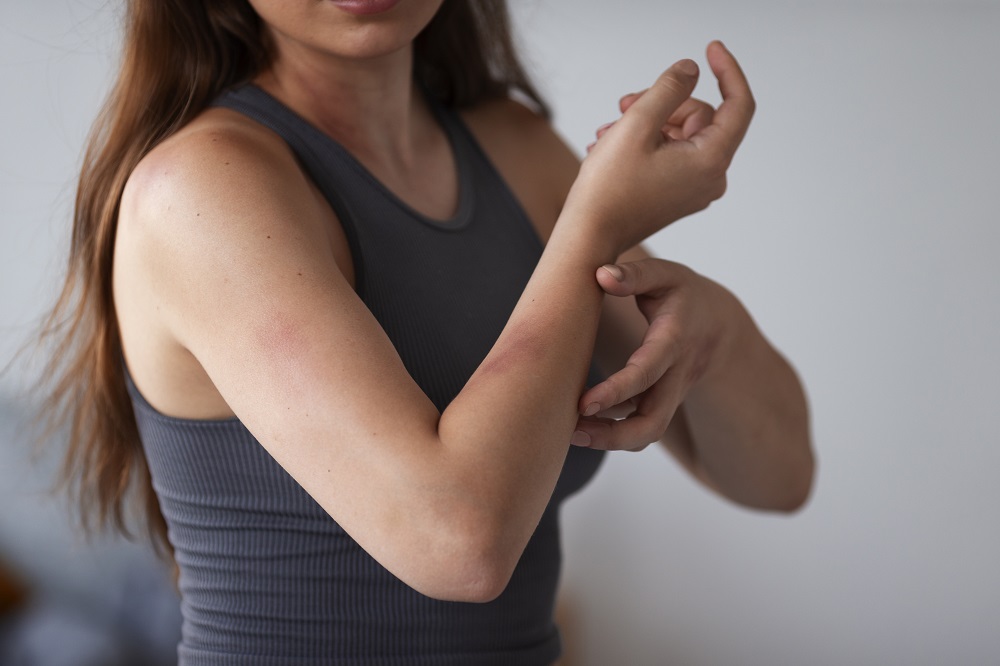 How to Get Rid of Heat Rash: